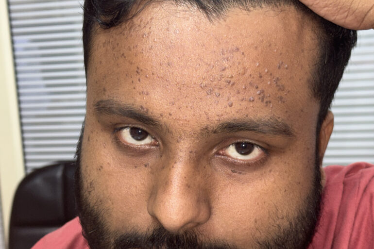 Flat warts since 2017 Got cured with classical Homeopathy