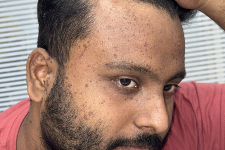 Flat warts since 2017 Got cured with classical Homeopathy