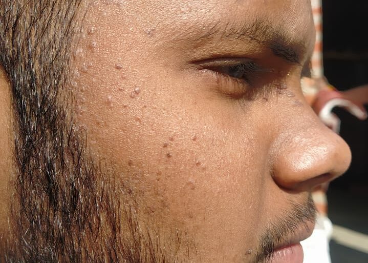 Flat warts For 4 years Got cured in 4 months- Case From Jaunpur