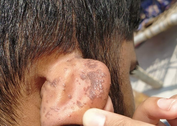 Flat warts For 4 years Got cured in 4 months- Case From Jaunpur