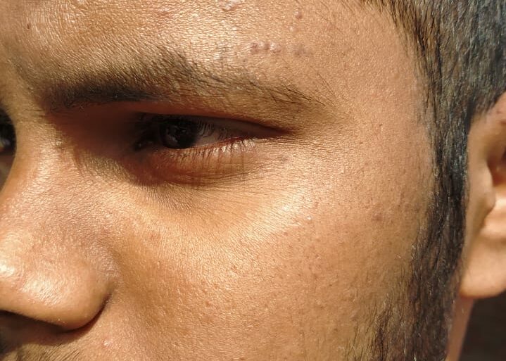 Flat warts For 4 years Got cured in 4 months- Case From Jaunpur