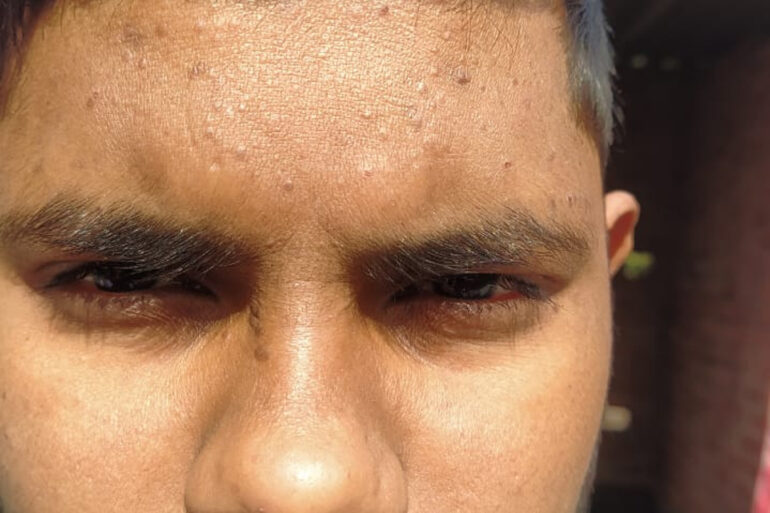 Flat warts For 4 years Got cured in 4 months- Case From Jaunpur
