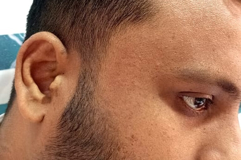 Flat warts since 2017 Got cured with classical Homeopathy