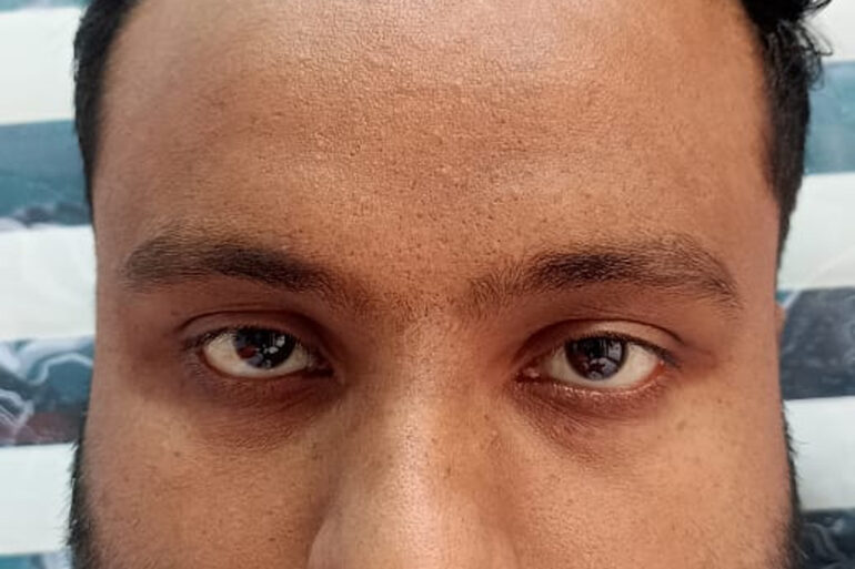 Flat warts since 2017 Got cured with classical Homeopathy