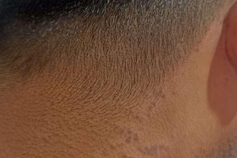 Flat warts since 2017 Got cured with classical Homeopathy