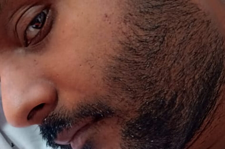 Flat warts since 2017 Got cured with classical Homeopathy